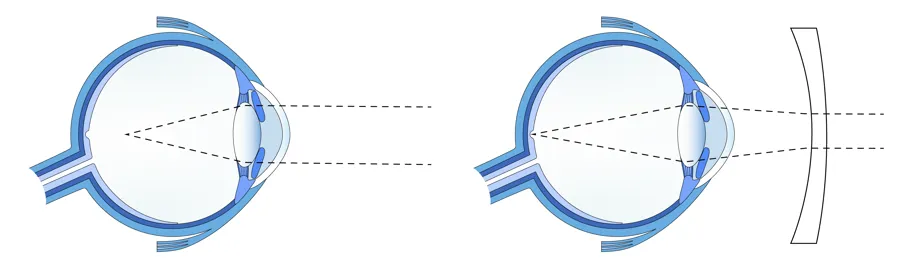 To illustrasjoner av øyeeple, til venstre vises nærsynthet, til høyre normalt syn med linse.