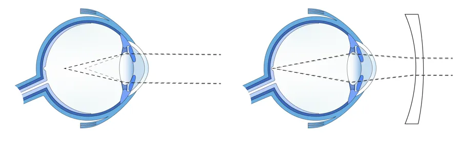 Illustrasjon av øyeepler, til venstre vises skjeve hornhinner, til høyre normalt syn med linse.
