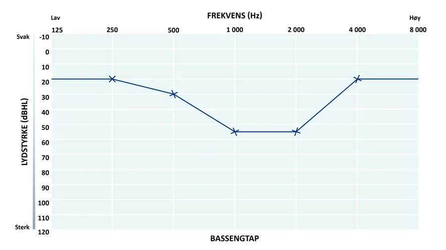 Audiogram som viser bassengtap.