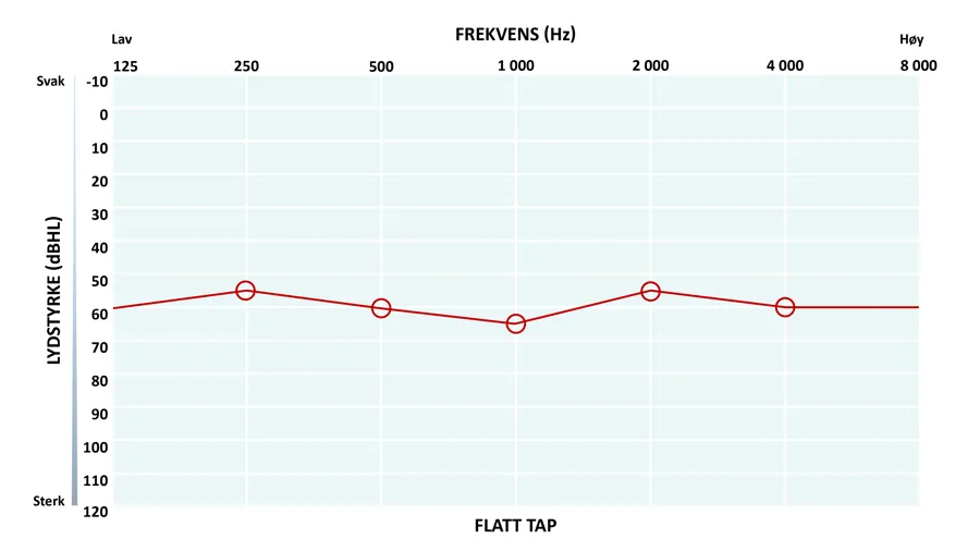 Audiogram som viser flatt hørselstap.